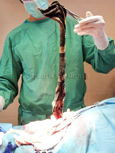 Rimozione di una calza dall'intestino