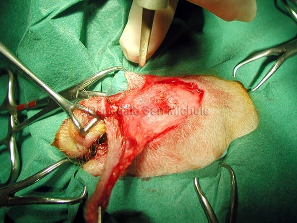 Otostomia con chirurgia laser
