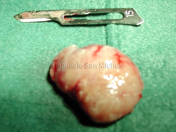 Meningioma cerebrale asportato