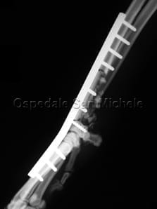 artrodesi_del_carpo