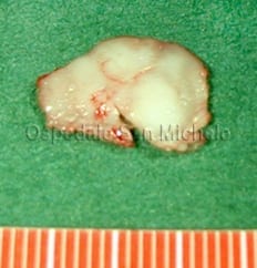 flapcartilagineo2