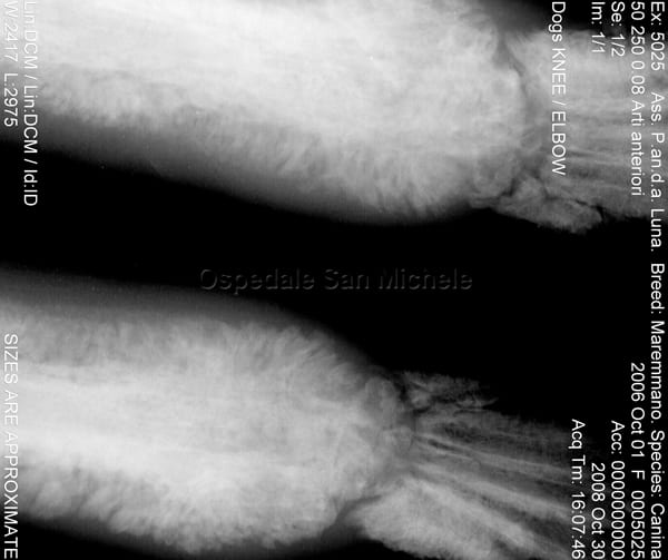Radiografia di un osteopatia polmonare ipertrofica