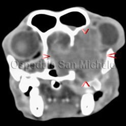 tac_carcinoma